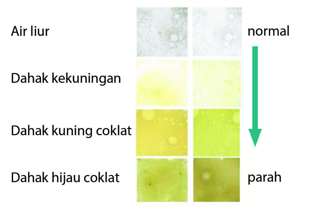 chart sputum